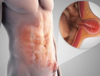 Πόνος και «ξαφνικό εξόγκωμα» στην κοιλιά - Πότε είναι βουβωνοκήλη – Τι πρέπει να κάνετε!